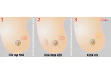 Memede Kistik Lezyon Belirtileri ve Tedavisi