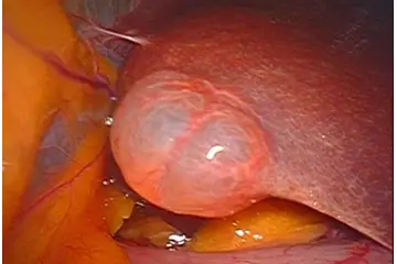 Kistik Lezyon Nedenleri Nelerdir?